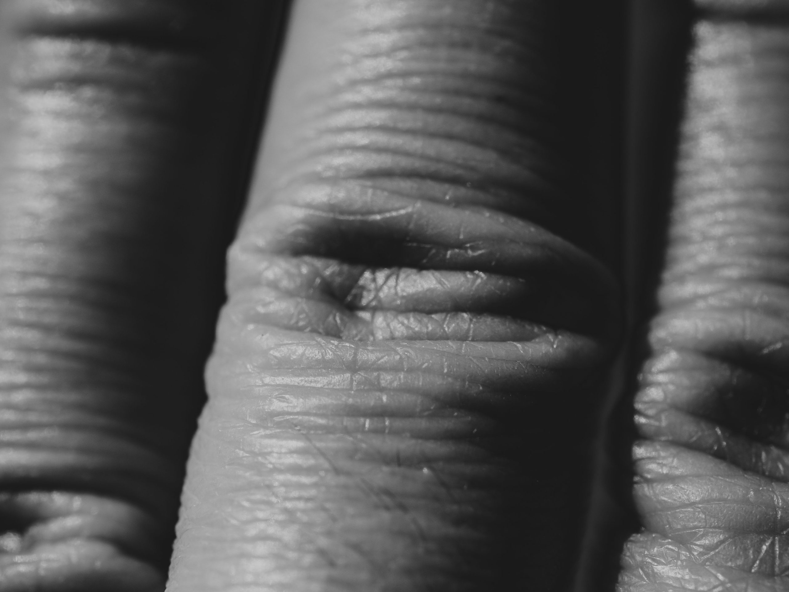 Kyste synovial du doigt - Traitement et solutions médicales