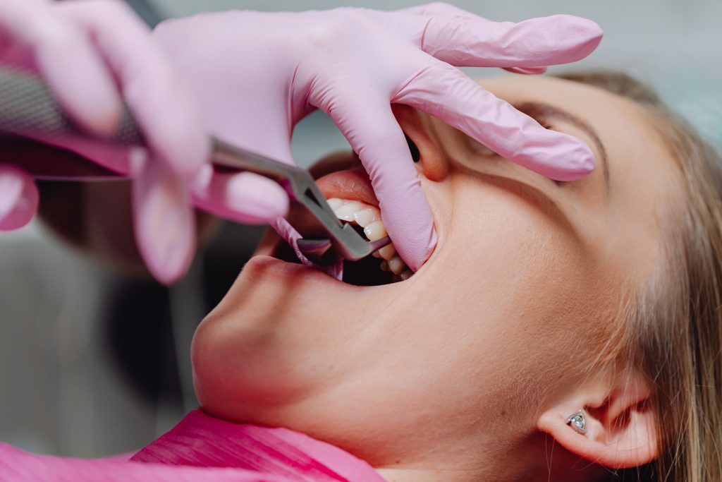 Granulome dentaire : comment savoir si tu es touché ?