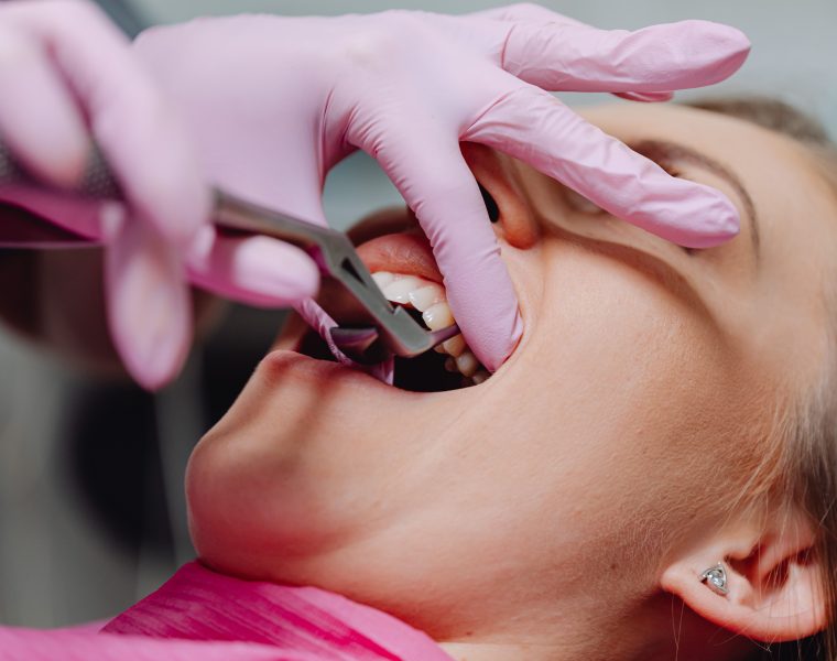 Granulome dentaire : comment savoir si tu es touché ?